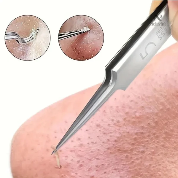 Outil de précision pour éliminer les poils incarnés facilement